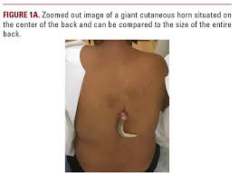 Image result for cornu cutaneum)