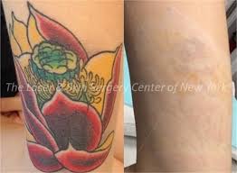 There are many laser tattoo removal in nyc that you can choose from. Tattoo Removal Service New York Nyc Laser Skin Center