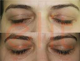 Xsanthalesma Ksantalesma Goz Kapagi Yag Birikimleri Q Sw Laser Ile Bir Seans Tedaviden 20 Gun Sonra Sizin De Benzer Problemlerin Estetik Guzellik Dugun