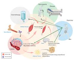 Image result for Cachexia in Cancer