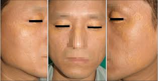 The symptoms and appearance of xanthomas should lessen or go away entirely once a person receives treatment for the underlying condition. Plane Xanthoma Yellowish Maculopapular Lesions Had Spread Over The Download Scientific Diagram