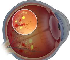 We did not find results for: Diabetes And Eyesight How Diabetes Affects Your Vision