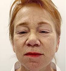 Scarlet Microneedling Lifts à Montréal