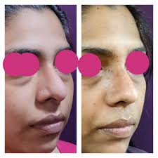 People get rhinoplasty to repair or change their nose after an injury, to fix breathing problems, or congenital disability. Nose Surgery Cost Bangalore Leading Nose Reshaping Rhinoplasty Surgeon In India