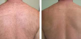 While laser hair removal can work on any body part you wish to remove hair from, it is especially effective on the laser hair removal works when the hair is in its active growth rate, she explains. Best Laser Hair Removal In Dubai Abu Dhabi Cmc Hair Removal