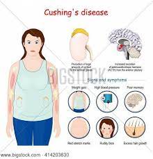 Cushing S Disease Vector Photo Free Trial Bigstock