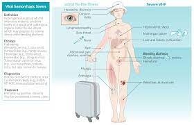 What are symptoms of marburg virus disease? Viral Hemorrhagic Fevers Knowledge Amboss