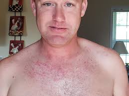 What causes a red rash with burning in the armpit?