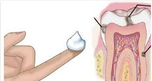 Adeus Caries Uma Forma Facil De Prevenir E Eliminar Caries Usando Apenas Oleo De Coco Cura Pela Natureza Caries Oleo De Coco Oil Pulling