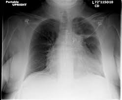 The symptoms may worsen gradually over several days or suddenly be very severe from the onset. Radiation Induced Lung Injury Pulmonology Advisor