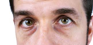 Circinus, de circus 1 ♦ (mil. Comment Enlever Les Cernes Sous Les Yeux Les Poches Sous Les Yeux 12 Astuces Pour En Finir Barb Art