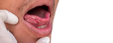 Image result for gum cancer symptoms