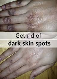 Diygoodtips Com Nbspthis Website Is For Sale Nbspdiygoodtips Resources And Information Dark Spots On Skin Skin Care Remedies Acne Dark Skin