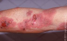 Image result for Pemphigoid