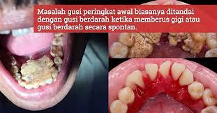 Karang gigi atau yang sering disebut dengan kalkulus gigi adalah. Karang Gigi Ini Yang Terjadi Kalau Tahi Gigi Tak Dicuci Dengan Betul Undang Masalah Gusi