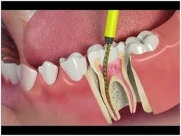 Check spelling or type a new query. How To Tell If You Need A Root Canal
