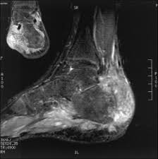 Bone cancer is rare, making up less than 1 percent of all cancers. Visual Diagnosis An Adolescent Who Has Swelling Of The Foot American Academy Of Pediatrics