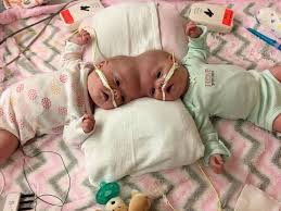 Fabric is shipped via united states first class mail for. Twins Who Survived One Of The Rarest Separation Surgeries In The World Are Now Thriving Toddlers Abc News