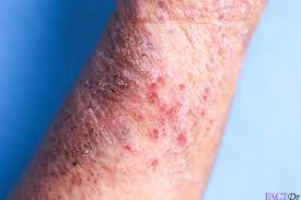 How is pellagra diagnosed and treated. Pellagra Causes Types Symptoms Treatment Factdr