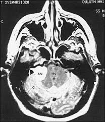 Tinnitus can be caused by many health conditions. Diagnostic Approach To Tinnitus American Family Physician