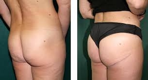 The cheeks are starting to sag and the fat is beginning before the procedure. Before And After Photos Gluteoplasty The Institute Of Plastic Surgery In Malmo Sweden