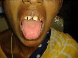 The syndrome is extremely rare. Full Text Iron Deficiency Anemia And Plummer Vinson Syndrome Current Insights Jbm