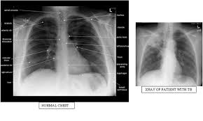 This ptb file type entry was marked as obsolete and no longer supported file format. Pulmonary Tuberculosis Ptb Case Study Page 3 Of 3 Nursing Crib