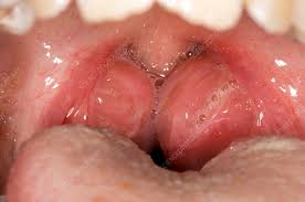 Image result for Tonsillitis