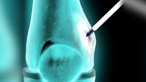 Image result for Radiofrequency Surgery