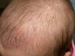 Cradle cap (seborrhoeic dermatitis) is a common and harmless skin condition that often affects young babies (harding 2016a, nhs 2017a). Cradle Cap Article