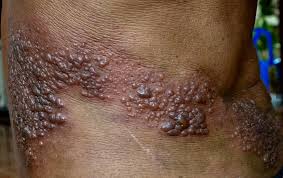 Image result for shingles