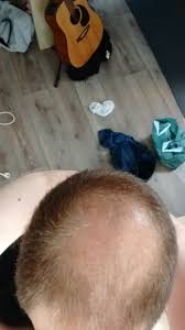 Nonetheless, it is very much back in design today! Haircut Balding Thin Men Styleforum