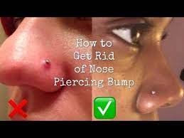 How to get rid of a keloid on nose. Buy How To Remove Keloids On Nose With A Reserve Price Up To 68 Off