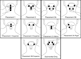 The Electrode Positions Relative To The Hyoid Bone Thyroid