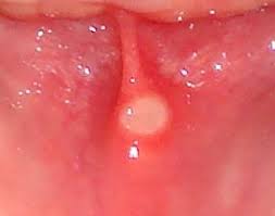 Image result for Canker sores roof of mouth
