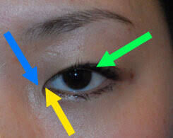 Check spelling or type a new query. Medial Epicanthoplasty For Epicanthal Folds Seattle Bellevue