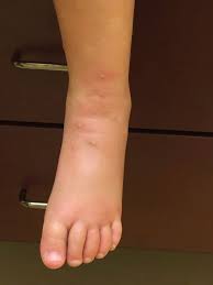 Image result for Fire Ant Sting