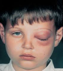 Image result for phlegmon on face)