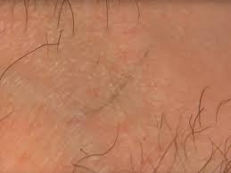 First, if you have an ingrown hair, the mayo clinic recommends that you stop shaving, tweezing, or waxing that area until it heals. The Best Ingrown Hair Removal Videos