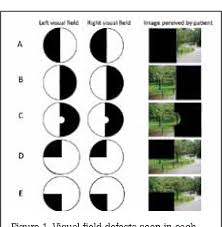 Image result for Visual Field Deficit