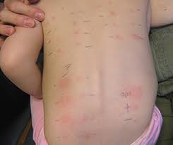 First, they'll put a small drop of liquid containing the food on your skin and. Can Skin Prick Tests Cause Food Allergy Michelle S Blog