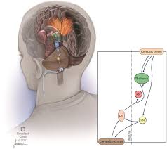 Image result for Thalamic Stimulation