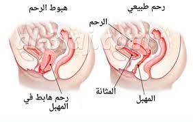 ما هو هبوط الرحم بالصور اسألينا
