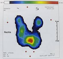 Eine unterfunktion der schilddrüse, die nicht behandelt wird,. Untersuchung Der Schilddruse Wikipedia