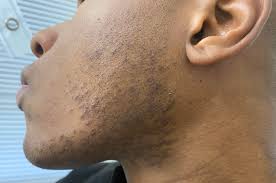 Image result for Hyperpigmentation