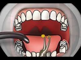Zu welcher zeit sollte man zusammenführen zahn ablagern lassen zahnmedizin. Schmerzen Nach Zahn Ziehen Die Alveolitis Youtube