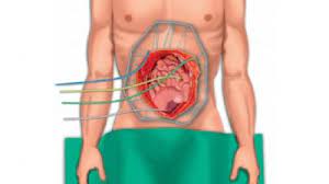 Whether peritoneal cancer starts in the peritoneum or spreads from somewhere else (colon, appendix, ovary), it is this could be related to a prior cancer that has now spread to the peritoneum or another cancer type known as a primary peritoneal cancer. Cancerul Peritoneal Simptome Èi SperanÈa De ViaÈÄ