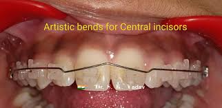 نتیجه جستجوی لغت [bends] در گوگل