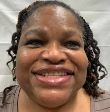 The Use of Split Temporalis Muscle Flap in Maxillofacial Reconstruction