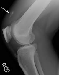 If your doctor thinks that your avulsion. Avulsion Fractures Of The Knee Imaging Findings And Clinical Significance Radiographics